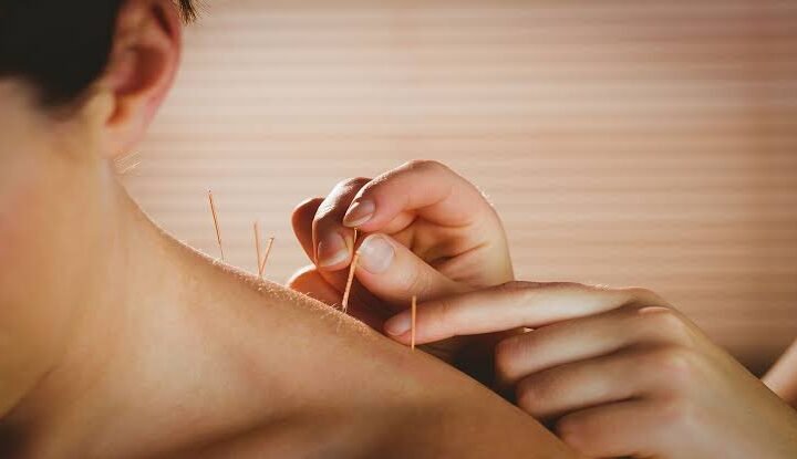 acupuncture benefits